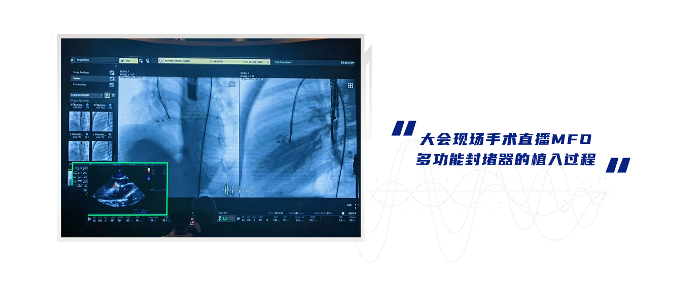 大会现场手术直播MFO多功效封堵器的植入历程.png