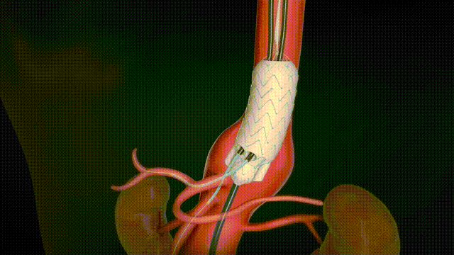 G-Branch 分支重修+髂内释放（深色无字幕20s）2024.10.11 00_00_00-00_00_30.gif